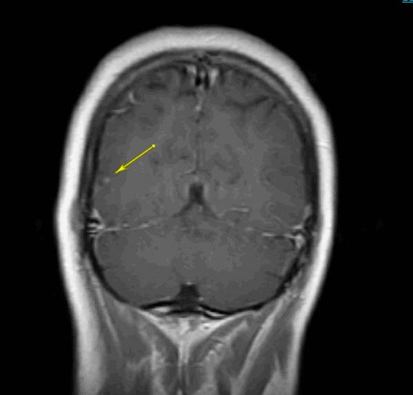 Scan of the 32-year-old woman's brain showing tapeworm larvae cysts. 
