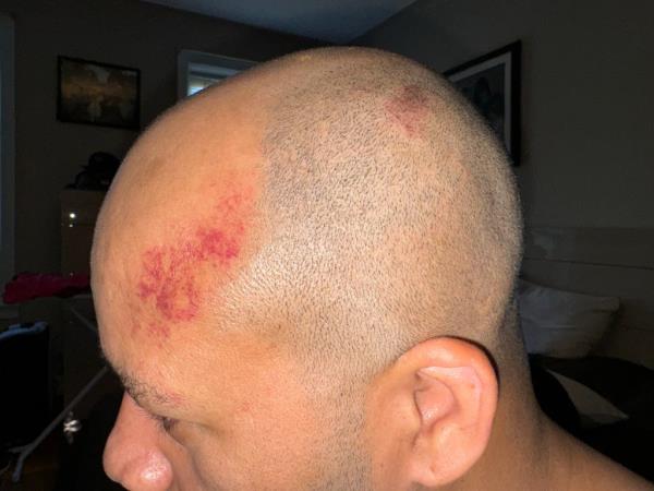 Johan with red bruising to head in the aftermath of an altercation with another family