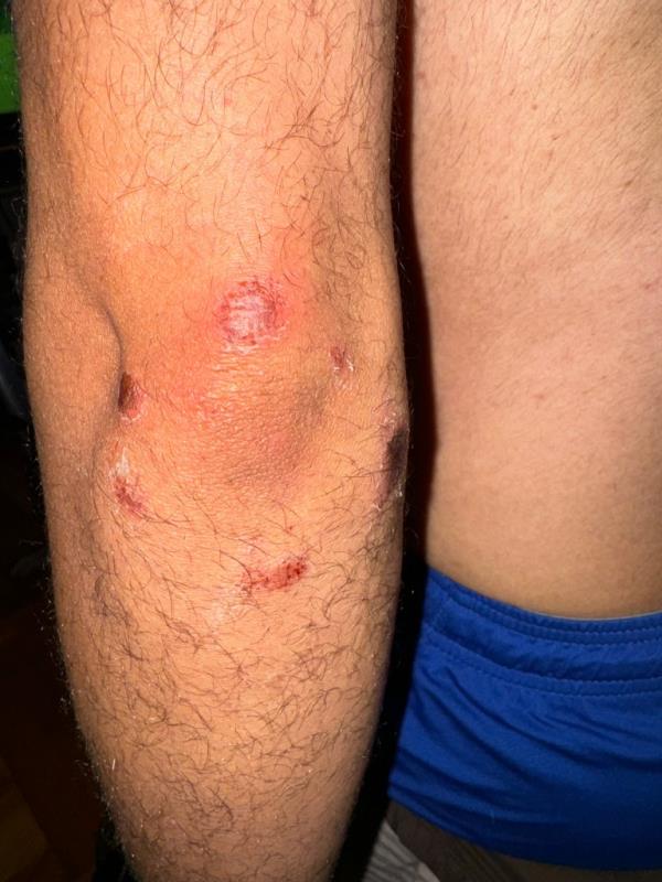 Man showing injuries on his arm after co<em></em>nfrontation at PS 682