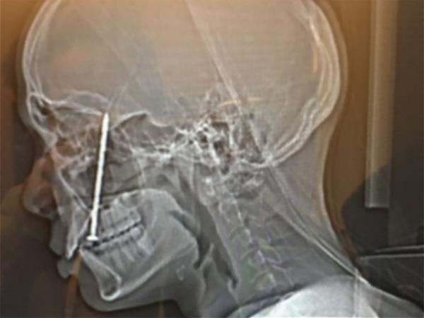 CT scan image of nail in man's head