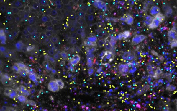 Major cause of inflammatory bowel disease discovered