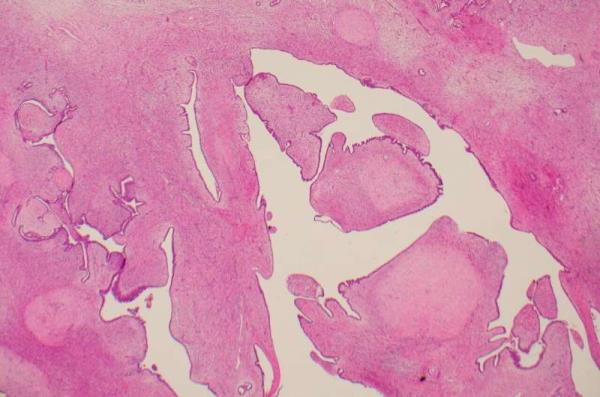 Biomarkers discovered for difficult-to-diagnose breast tumour